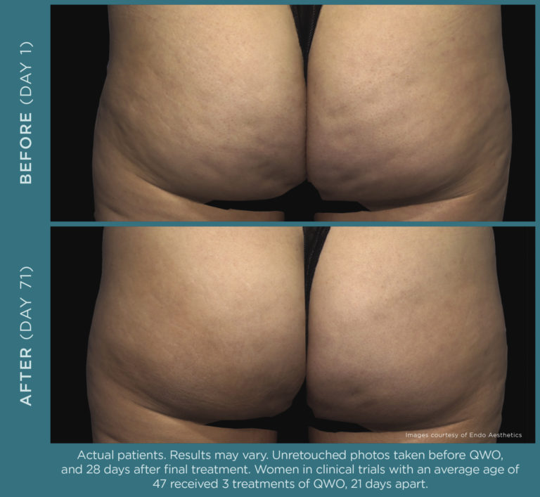 Qwo injectable for moderate to severe cellulite in the buttocks.