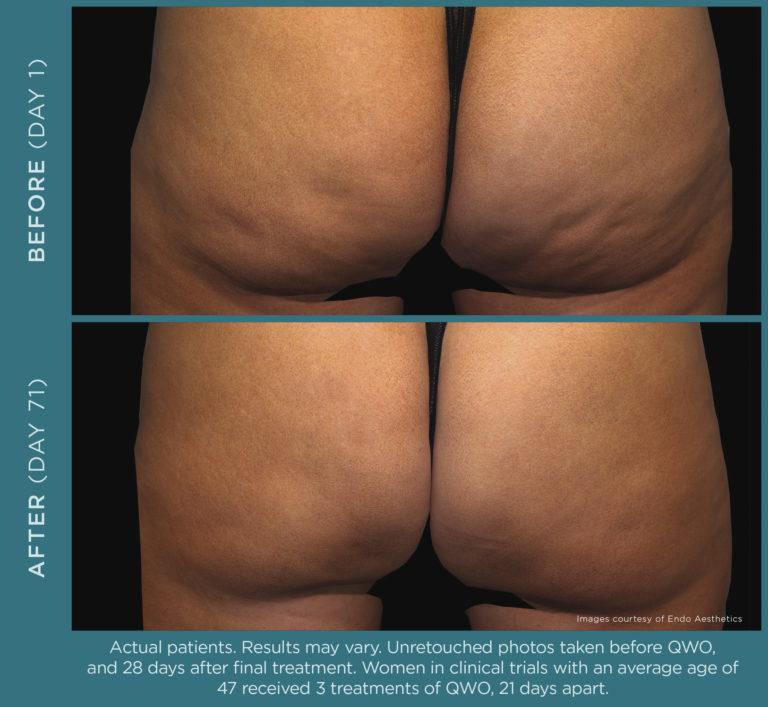 Qwo injectable for moderate to severe cellulite in the buttocks.