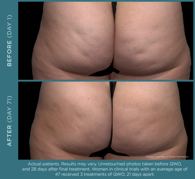 Qwo injectable for moderate to severe cellulite in the buttocks.